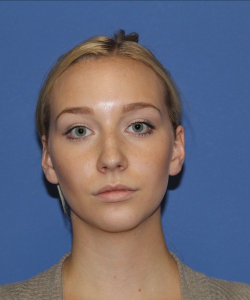 Rhinoplasty 1377 – Click HERE for more views before photo. Individual results may vary.