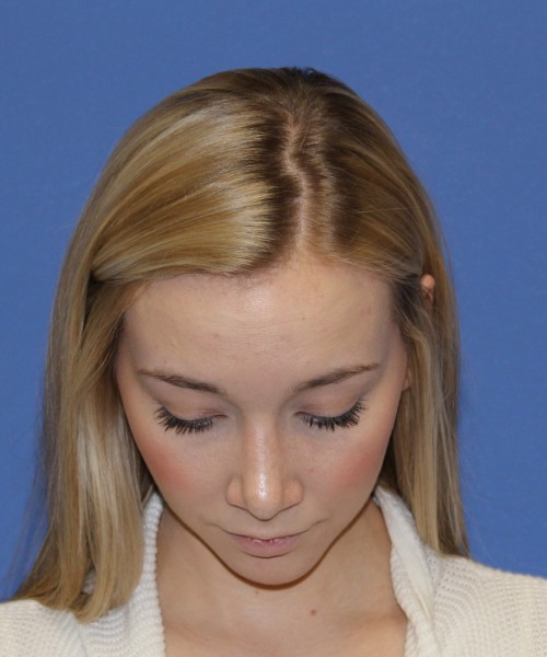 Rhinoplasty 1377 – Click HERE for more views after photo. Individual results may vary.