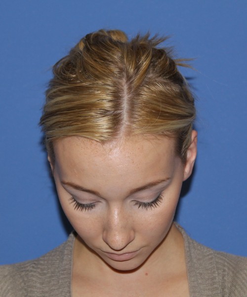 Rhinoplasty 1377 – Click HERE for more views before photo. Individual results may vary.