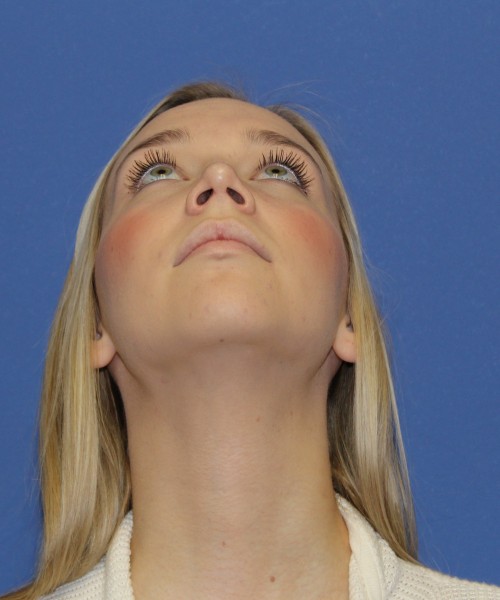 Rhinoplasty 1377 – Click HERE for more views after photo. Individual results may vary.