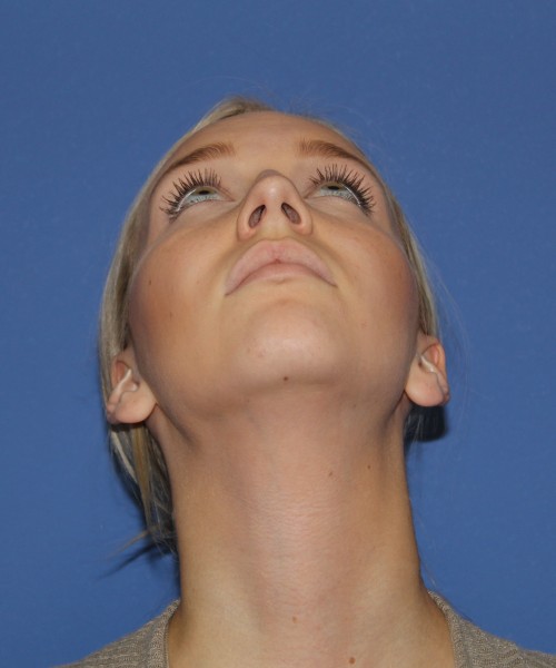 Rhinoplasty 1377 – Click HERE for more views before photo. Individual results may vary.