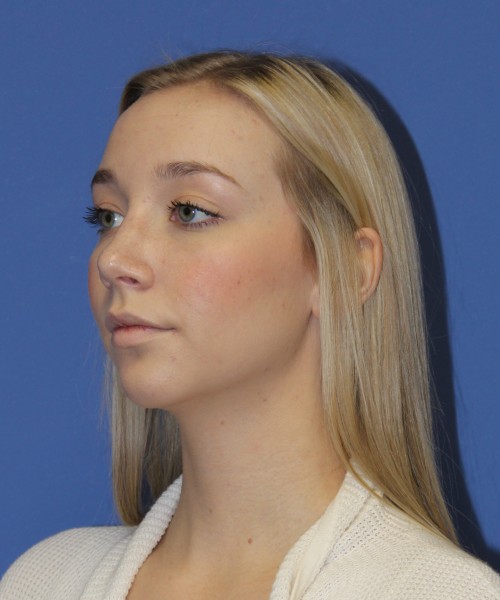 Rhinoplasty 1377 – Click HERE for more views after photo. Individual results may vary.