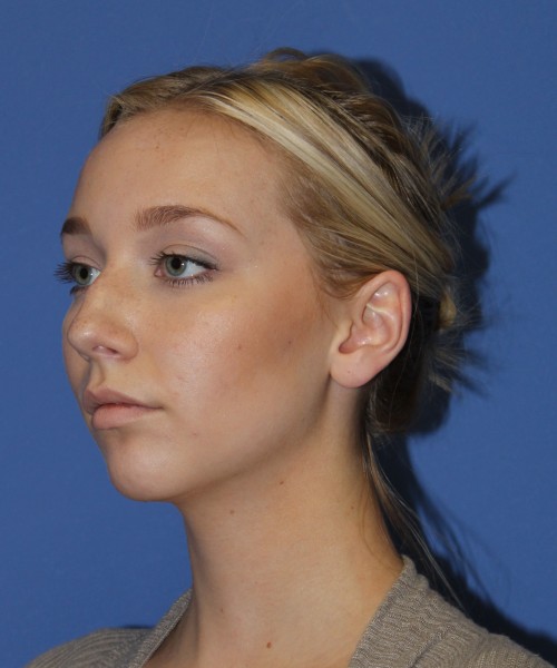 Rhinoplasty 1377 – Click HERE for more views before photo. Individual results may vary.