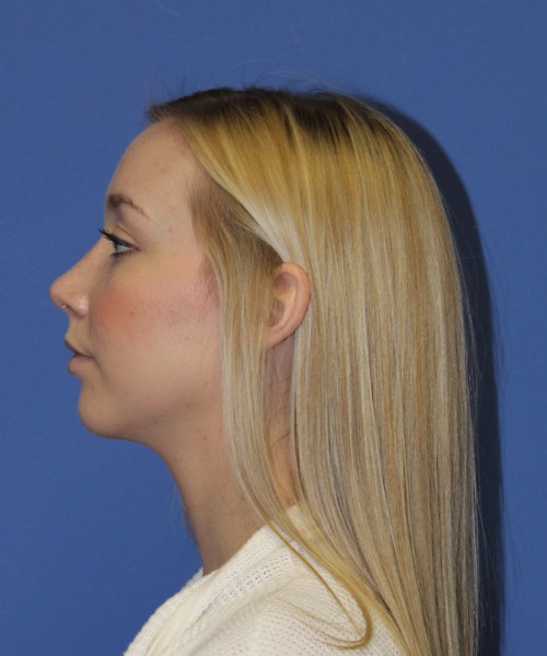 Rhinoplasty 1377 – Click HERE for more views after photo. Individual results may vary.