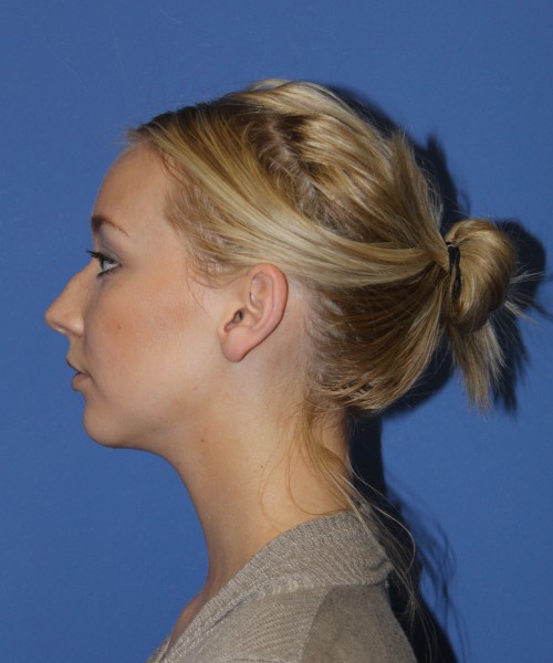 Rhinoplasty 1377 – Click HERE for more views before photo. Individual results may vary.