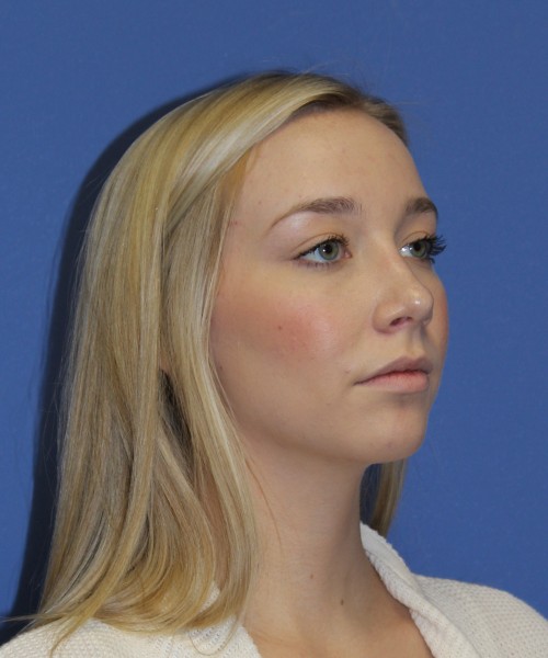 Rhinoplasty 1377 – Click HERE for more views after photo. Individual results may vary.