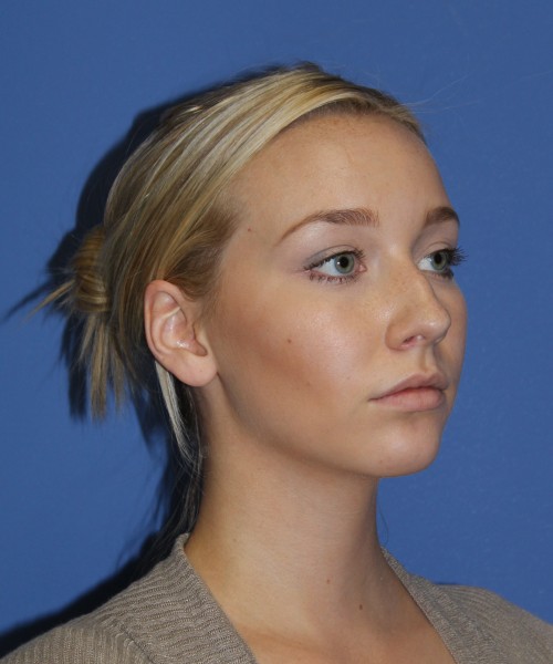 Rhinoplasty 1377 – Click HERE for more views before photo. Individual results may vary.