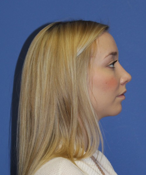 Rhinoplasty 1377 – Click HERE for more views after photo. Individual results may vary.