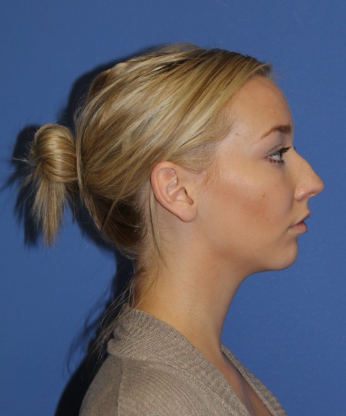 Rhinoplasty 1377 – Click HERE for more views before photo. Individual results may vary.