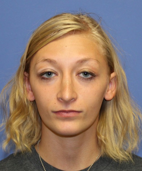 Rhinoplasty 1378 – Click HERE for more views after photo. Individual results may vary.