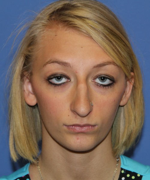Rhinoplasty 1378 – Click HERE for more views before photo. Individual results may vary.