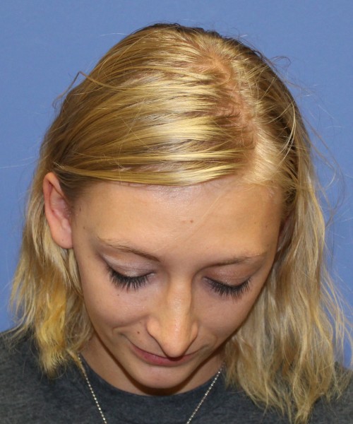 Rhinoplasty 1378 – Click HERE for more views after photo. Individual results may vary.