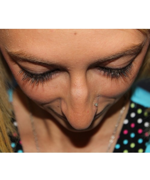 Rhinoplasty 1378 – Click HERE for more views before photo. Individual results may vary.