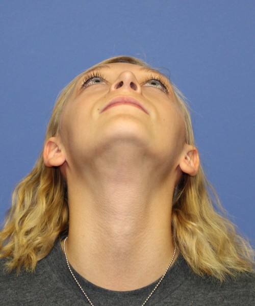 Rhinoplasty 1378 – Click HERE for more views after photo. Individual results may vary.