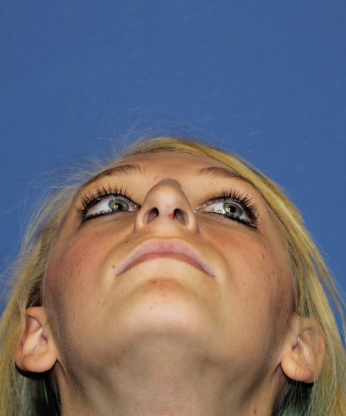 Rhinoplasty 1378 – Click HERE for more views before photo. Individual results may vary.