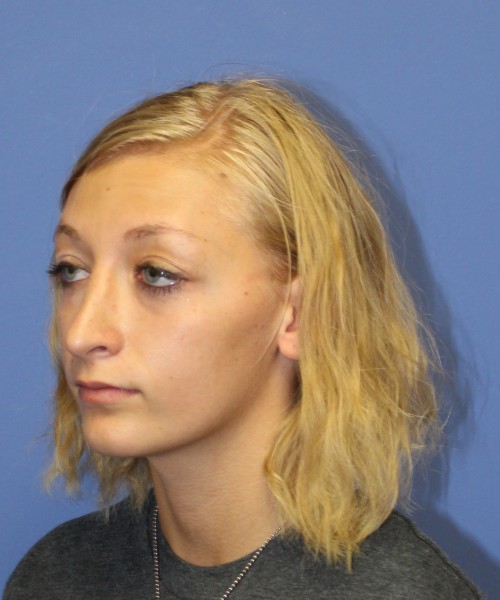 Rhinoplasty 1378 – Click HERE for more views after photo. Individual results may vary.