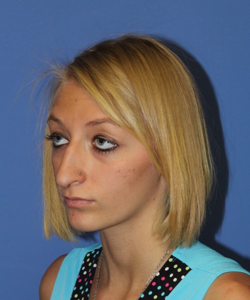 Rhinoplasty 1378 – Click HERE for more views before photo. Individual results may vary.