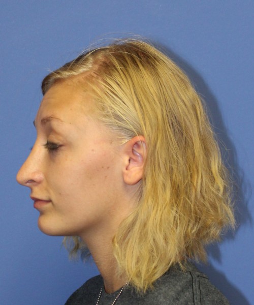 Rhinoplasty 1378 – Click HERE for more views after photo. Individual results may vary.