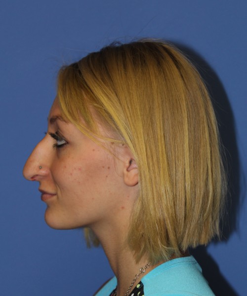 Rhinoplasty 1378 – Click HERE for more views before photo. Individual results may vary.