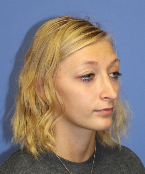 Rhinoplasty 1378 – Click HERE for more views after photo. Individual results may vary.
