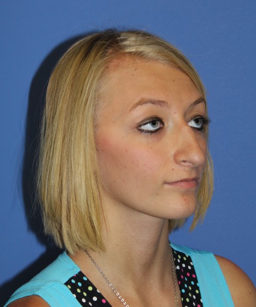 Rhinoplasty 1378 – Click HERE for more views before photo. Individual results may vary.