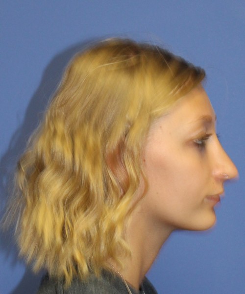 Rhinoplasty 1378 – Click HERE for more views after photo. Individual results may vary.