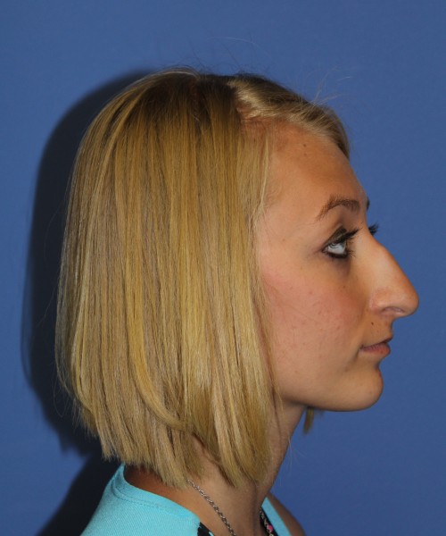 Rhinoplasty 1378 – Click HERE for more views before photo. Individual results may vary.