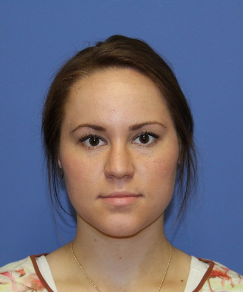 Rhinoplasty 1379 – Click HERE for more views after photo. Individual results may vary.