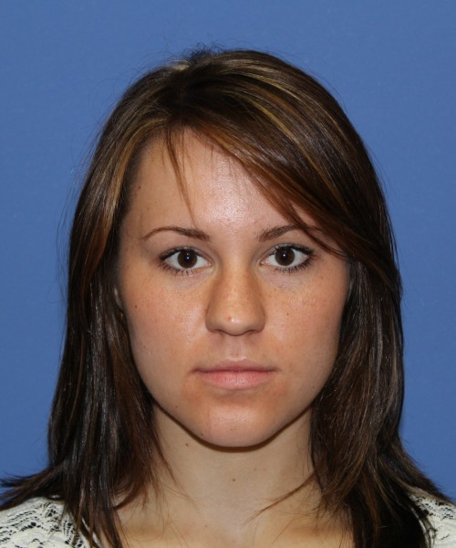 Rhinoplasty 1379 – Click HERE for more views before photo. Individual results may vary.
