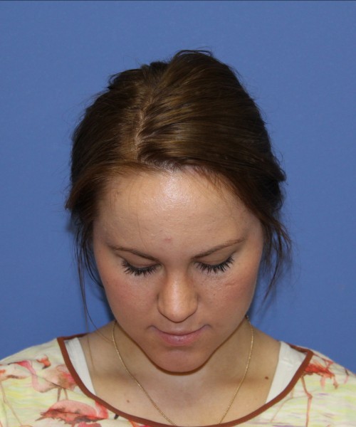 Rhinoplasty 1379 – Click HERE for more views after photo. Individual results may vary.