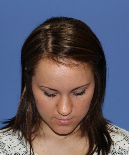 Rhinoplasty 1379 – Click HERE for more views before photo. Individual results may vary.