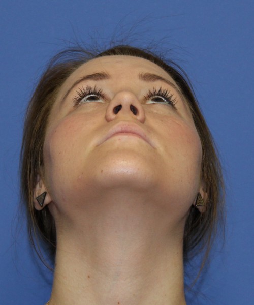 Rhinoplasty 1379 – Click HERE for more views after photo. Individual results may vary.