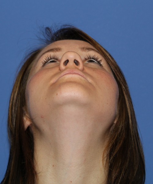 Rhinoplasty 1379 – Click HERE for more views before photo. Individual results may vary.