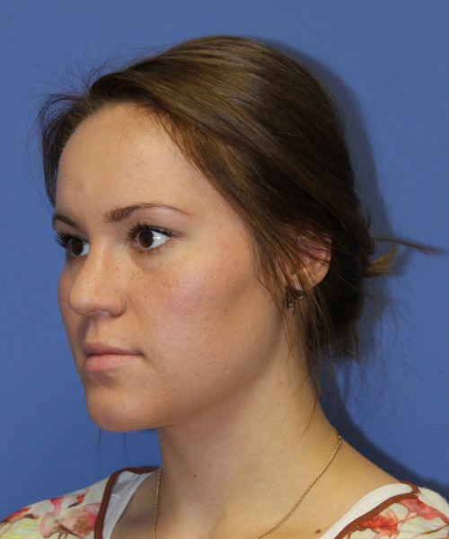 Rhinoplasty 1379 – Click HERE for more views after photo. Individual results may vary.