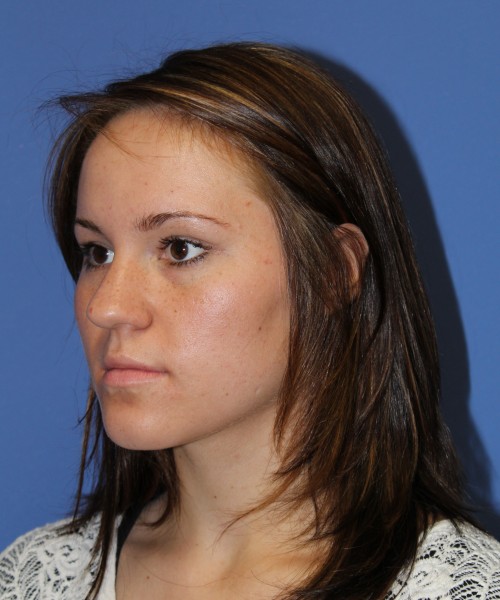 Rhinoplasty 1379 – Click HERE for more views before photo. Individual results may vary.