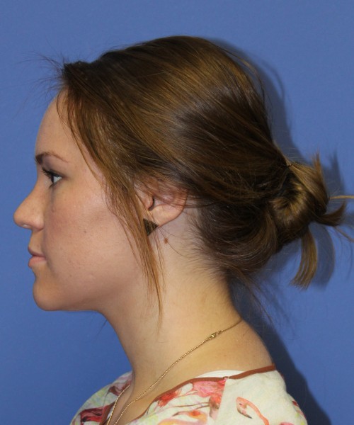 Rhinoplasty 1379 – Click HERE for more views after photo. Individual results may vary.
