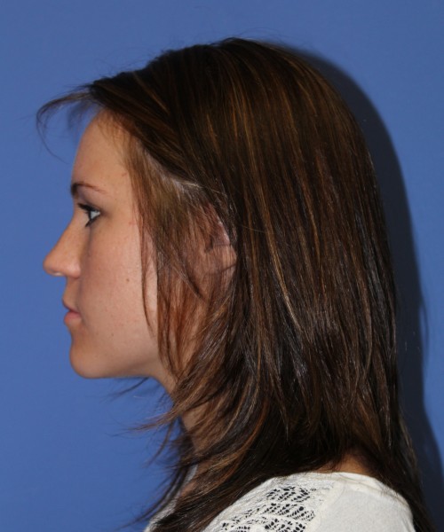 Rhinoplasty 1379 – Click HERE for more views before photo. Individual results may vary.