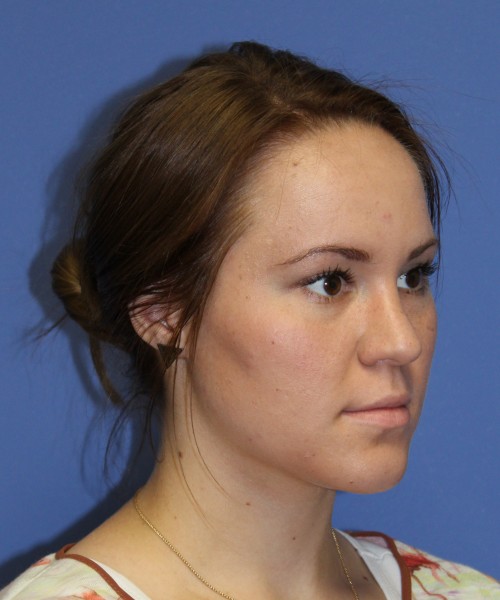 Rhinoplasty 1379 – Click HERE for more views after photo. Individual results may vary.