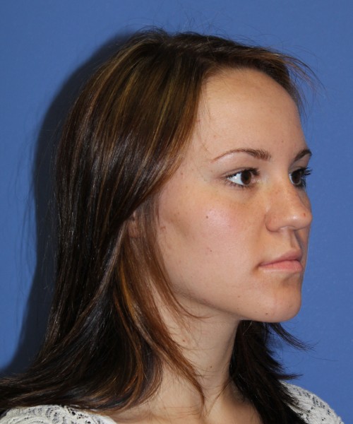 Rhinoplasty 1379 – Click HERE for more views before photo. Individual results may vary.