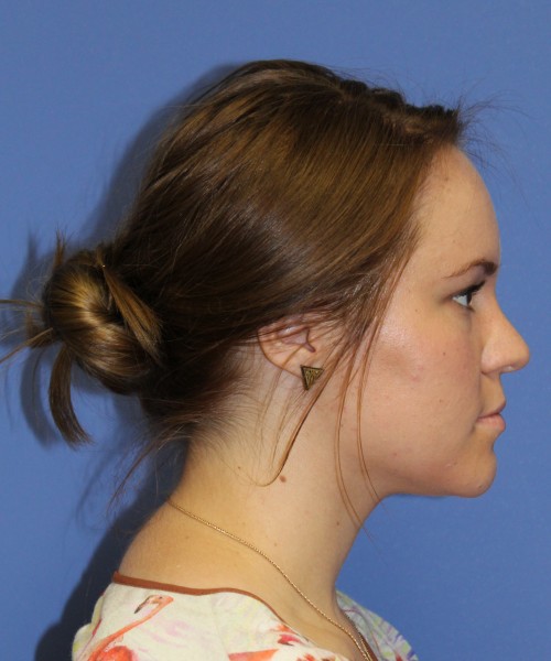 Rhinoplasty 1379 – Click HERE for more views after photo. Individual results may vary.