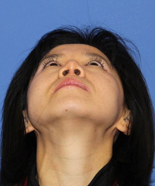 Rhinoplasty 1437 – Click HERE for more views after photo. Individual results may vary.