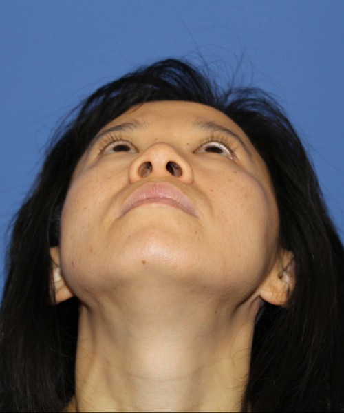 Rhinoplasty 1437 – Click HERE for more views before photo. Individual results may vary.