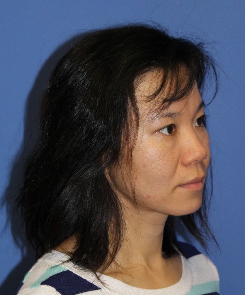 Rhinoplasty 1437 – Click HERE for more views before photo. Individual results may vary.