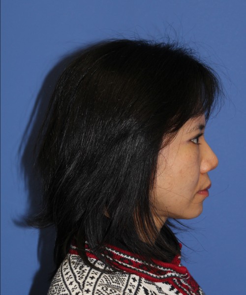Rhinoplasty 1437 – Click HERE for more views after photo. Individual results may vary.