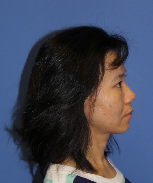 Rhinoplasty 1437 – Click HERE for more views before photo. Individual results may vary.