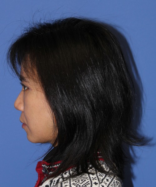 Rhinoplasty 1437 – Click HERE for more views after photo. Individual results may vary.