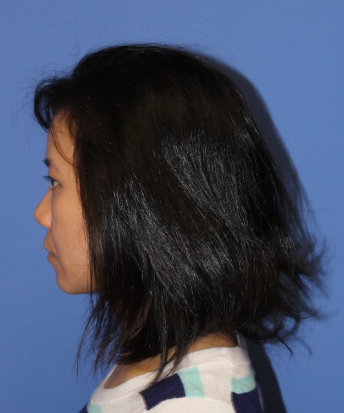 Rhinoplasty 1437 – Click HERE for more views before photo. Individual results may vary.