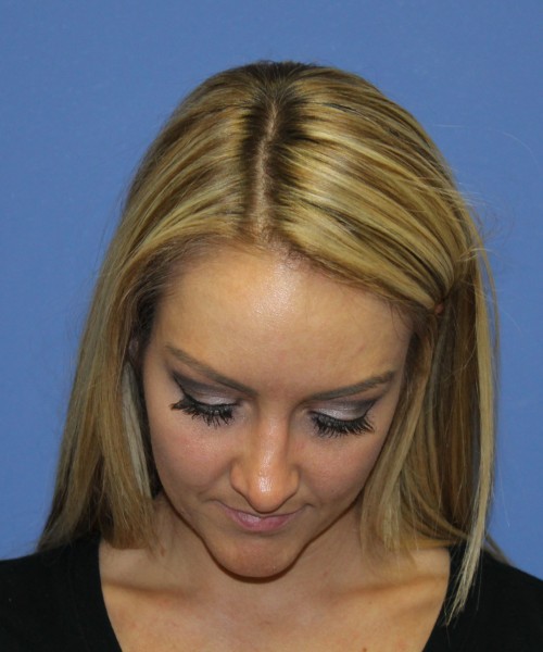 Rhinoplasty 1438 – Click HERE for more views after photo. Individual results may vary.