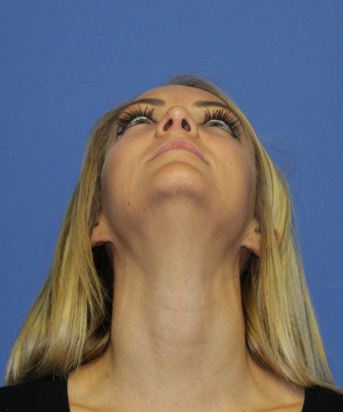 Rhinoplasty 1438 – Click HERE for more views after photo. Individual results may vary.
