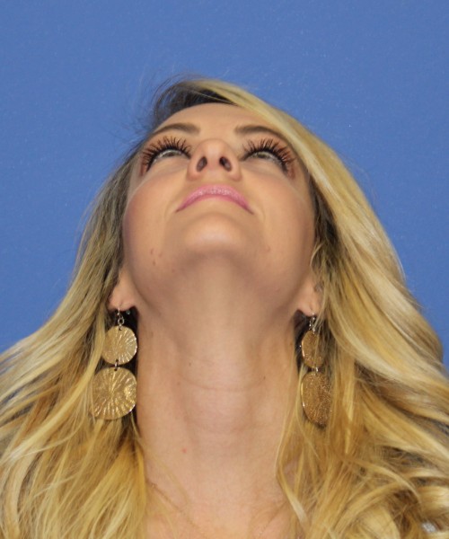 Rhinoplasty 1438 – Click HERE for more views before photo. Individual results may vary.